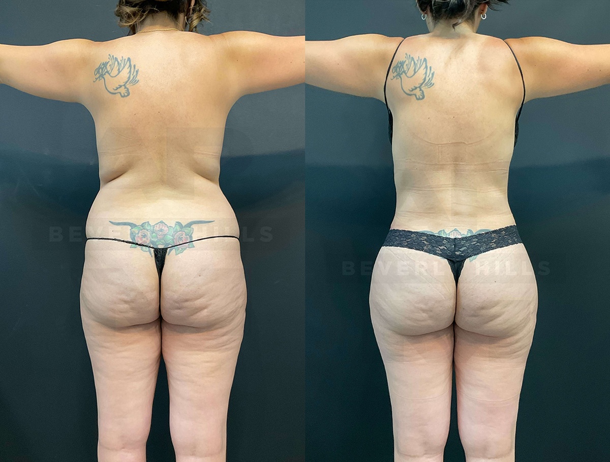 Real Patient Results of Dr. Andre P. Marshall providing Plastic Surgery services to his Beverly Hills & Los Angeles patients.