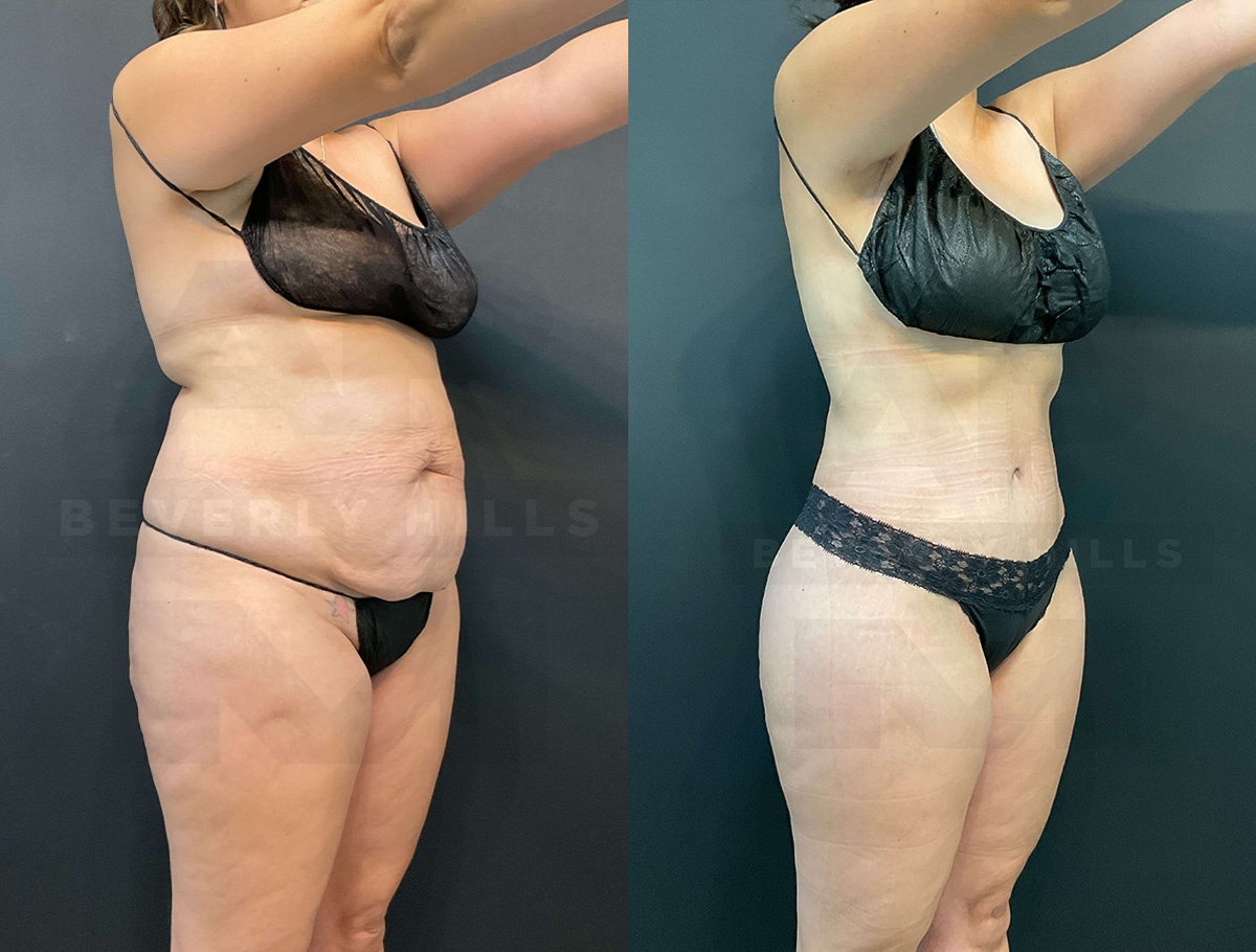 Real Patient Results of Dr. Andre P. Marshall providing Plastic Surgery services to his Beverly Hills & Los Angeles patients.