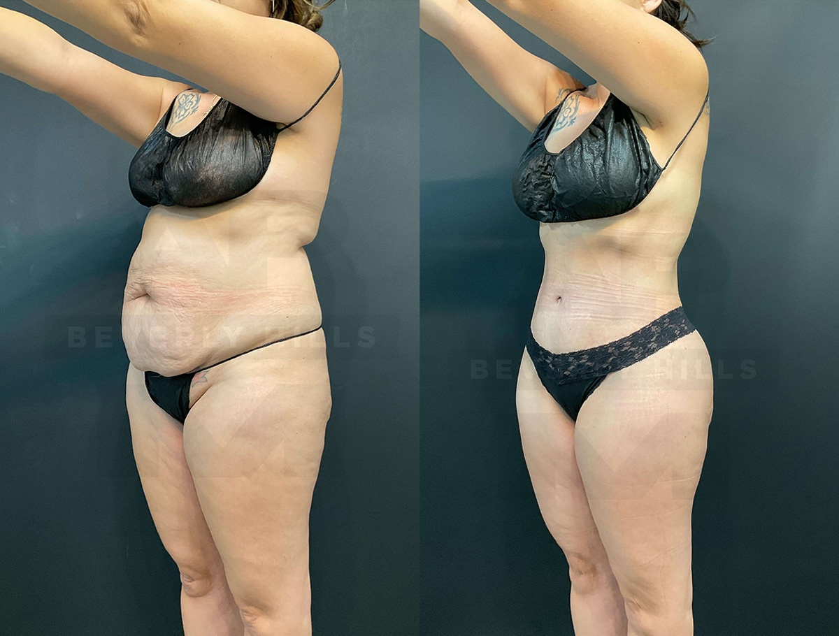 Real Patient Results of Dr. Andre P. Marshall providing Plastic Surgery services to his Beverly Hills & Los Angeles patients.