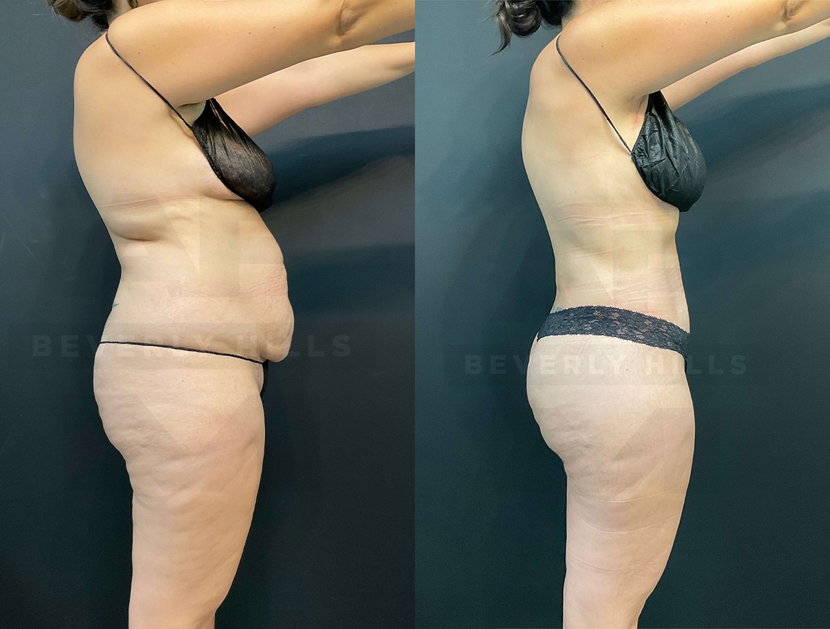 Real Patient Results of Dr. Andre P. Marshall providing Plastic Surgery services to his Beverly Hills & Los Angeles patients.