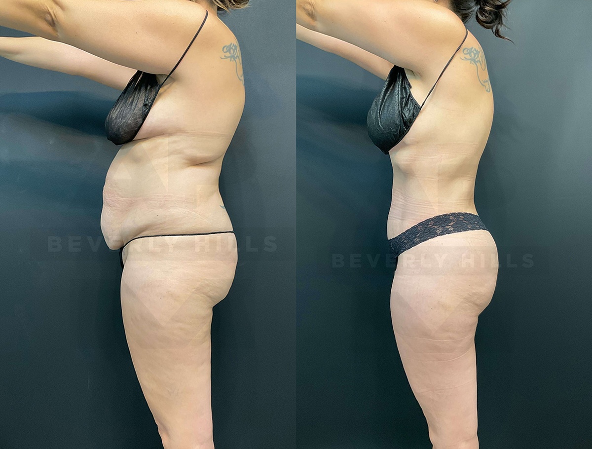 Real Patient Results of Dr. Andre P. Marshall providing Plastic Surgery services to his Beverly Hills & Los Angeles patients.