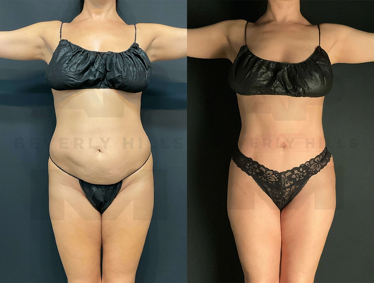 Real Patient Results of Dr. Andre P. Marshall providing Plastic Surgery services to his Beverly Hills & Los Angeles patients.