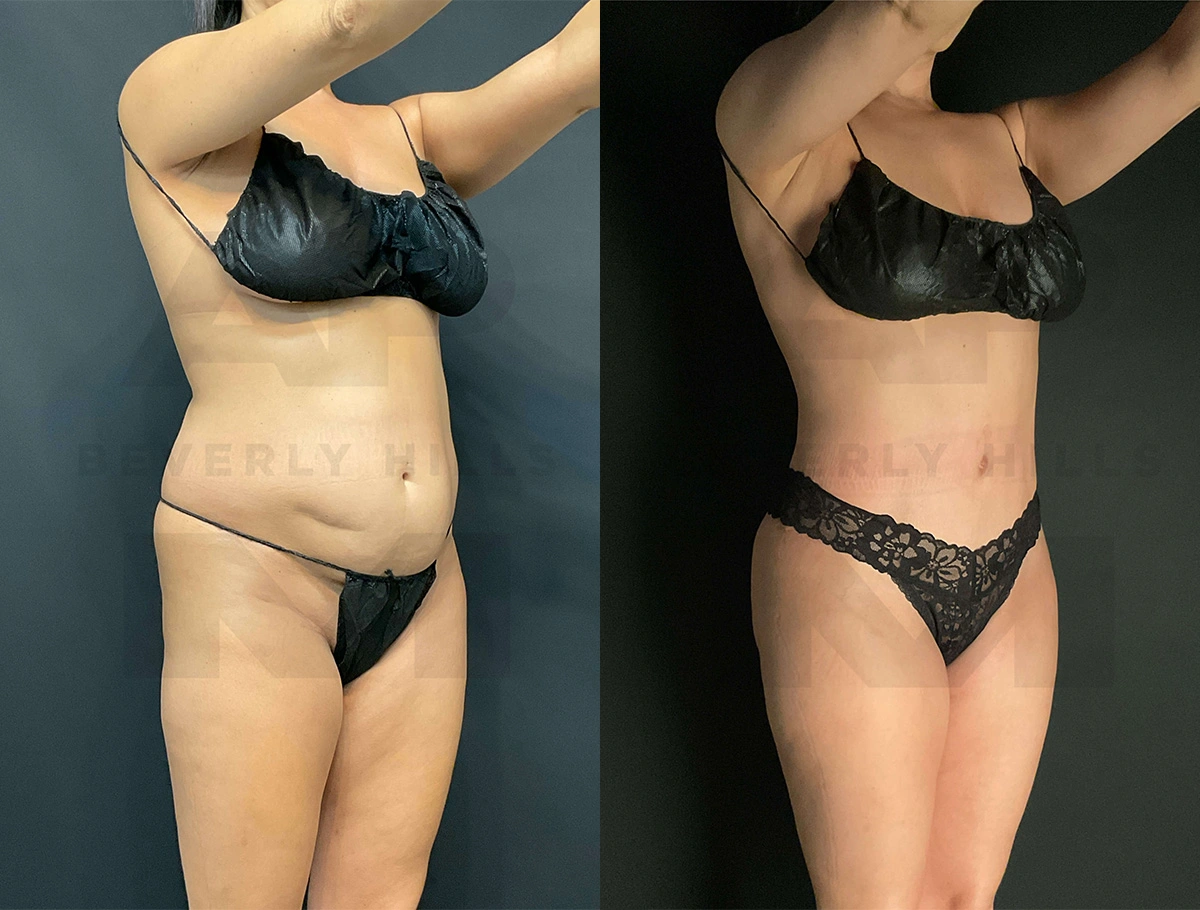 Real Patient Results of Dr. Andre P. Marshall providing Plastic Surgery services to his Beverly Hills & Los Angeles patients.