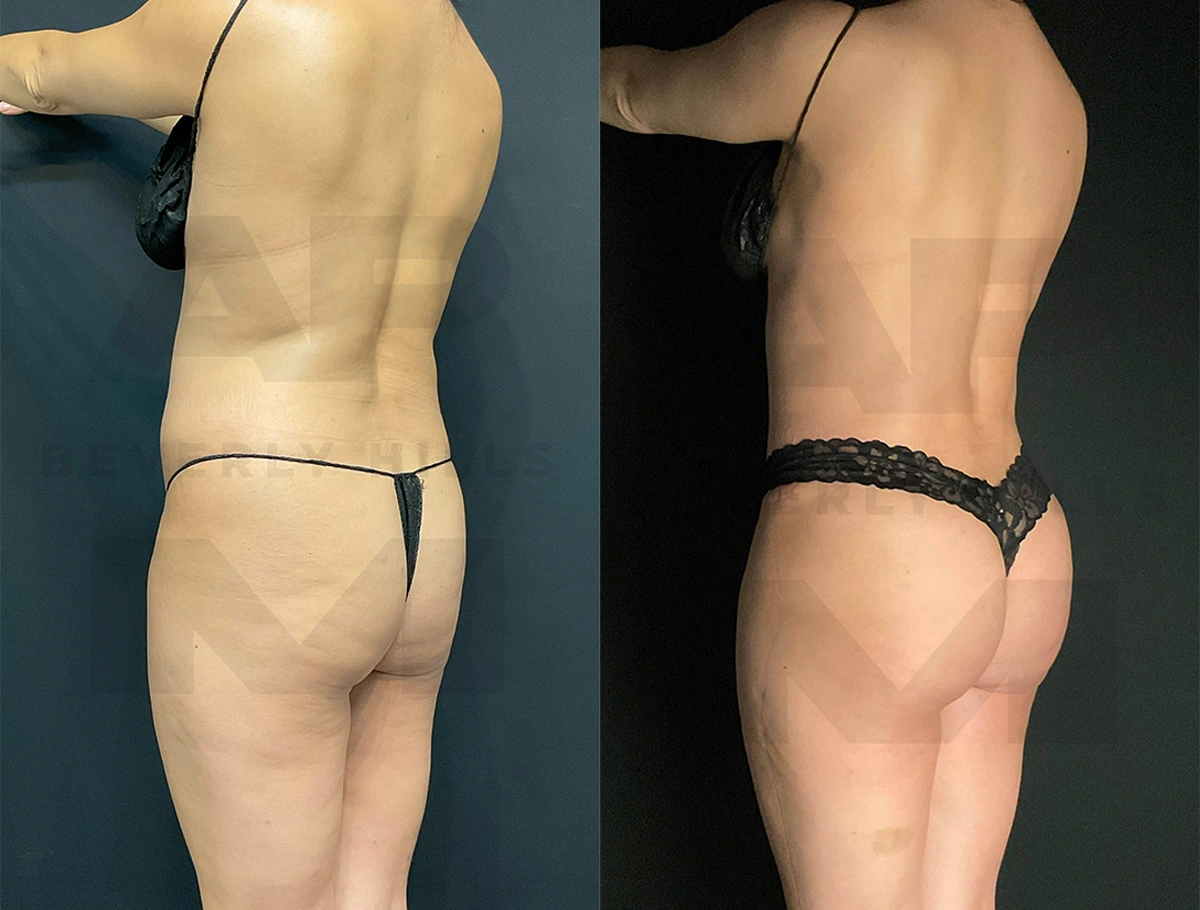 Real Patient Results of Dr. Andre P. Marshall providing Plastic Surgery services to his Beverly Hills & Los Angeles patients.