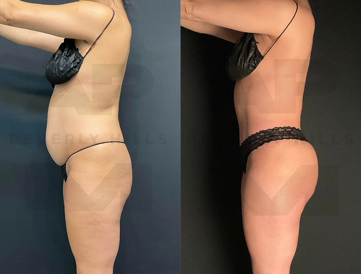 Real Patient Results of Dr. Andre P. Marshall providing Plastic Surgery services to his Beverly Hills & Los Angeles patients.