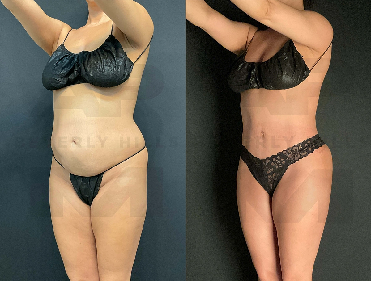 Real Patient Results of Dr. Andre P. Marshall providing Plastic Surgery services to his Beverly Hills & Los Angeles patients.