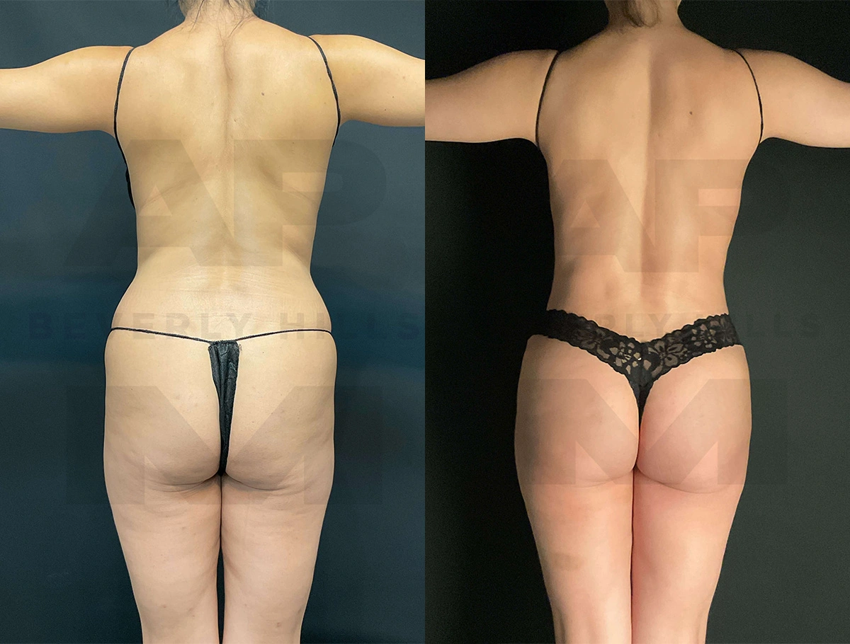 Real Patient Results of Dr. Andre P. Marshall providing Plastic Surgery services to his Beverly Hills & Los Angeles patients.