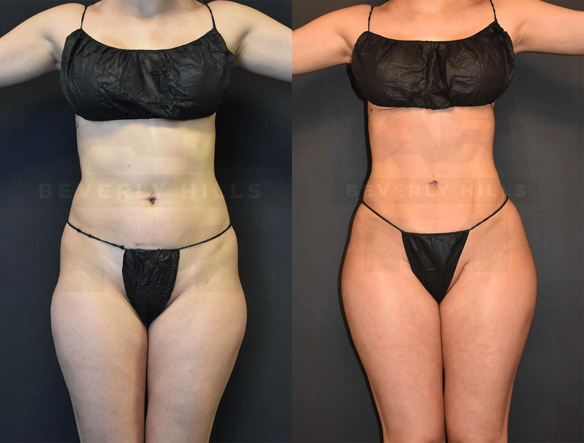 Real Patient Results of Dr. Andre P. Marshall providing Plastic Surgery services to his Beverly Hills & Los Angeles patients.