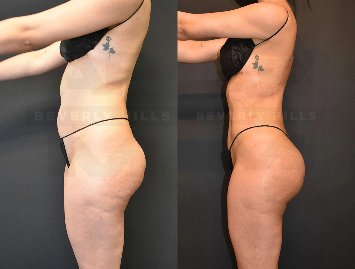 Real Patient Results of Dr. Andre P. Marshall providing Plastic Surgery services to his Beverly Hills & Los Angeles patients.