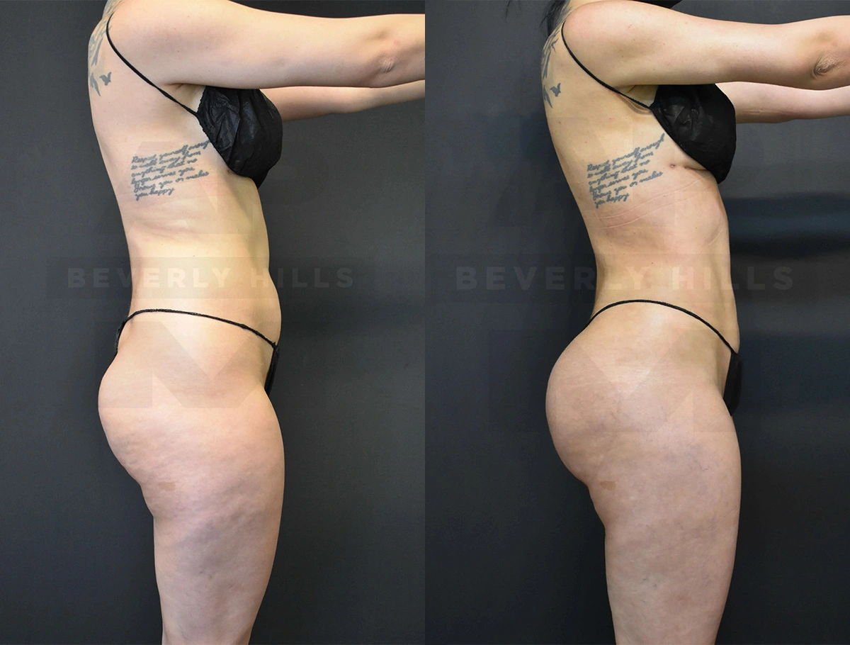 Real Patient Results of Dr. Andre P. Marshall providing Plastic Surgery services to his Beverly Hills & Los Angeles patients.