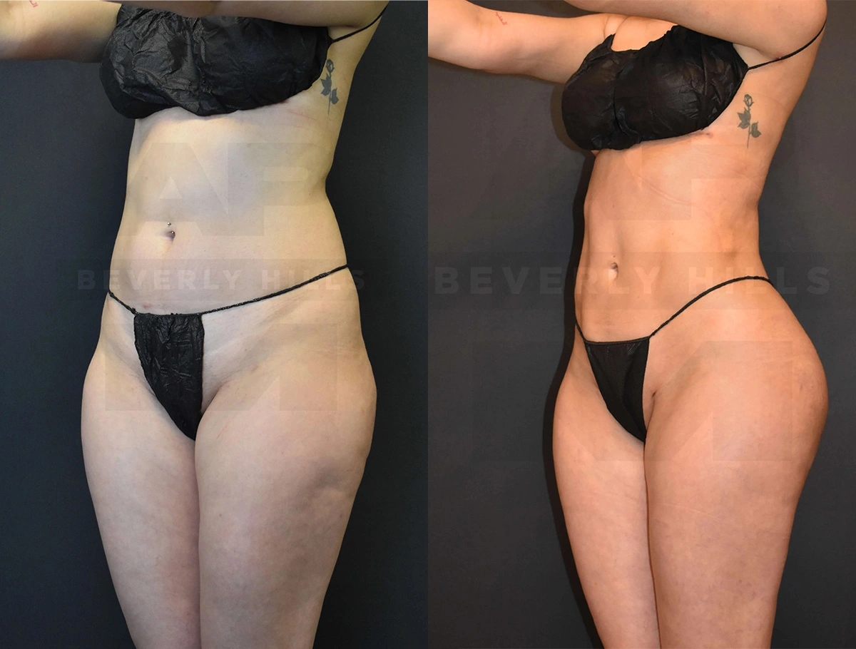 Real Patient Results of Dr. Andre P. Marshall providing Plastic Surgery services to his Beverly Hills & Los Angeles patients.