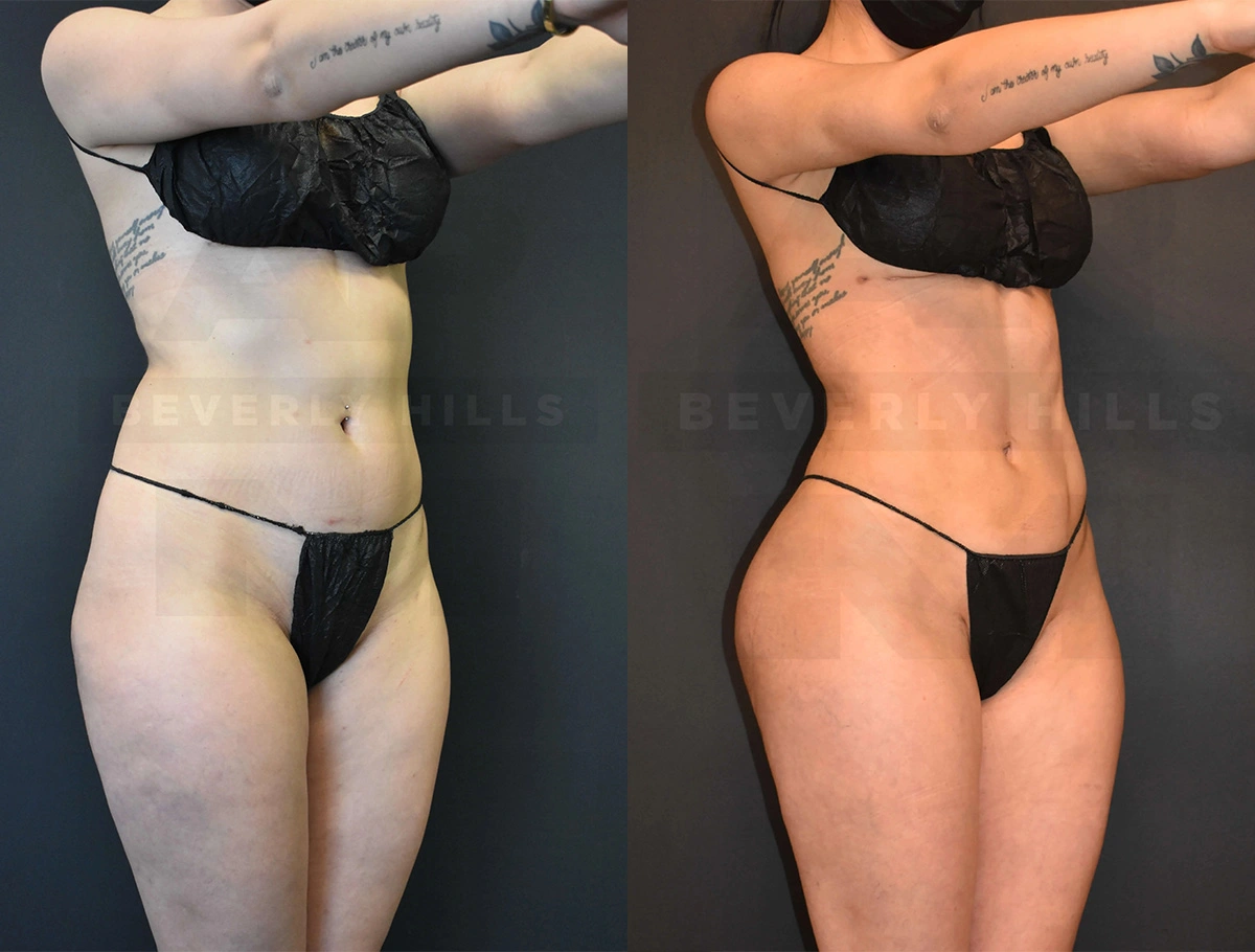 Real Patient Results of Dr. Andre P. Marshall providing Plastic Surgery services to his Beverly Hills & Los Angeles patients.