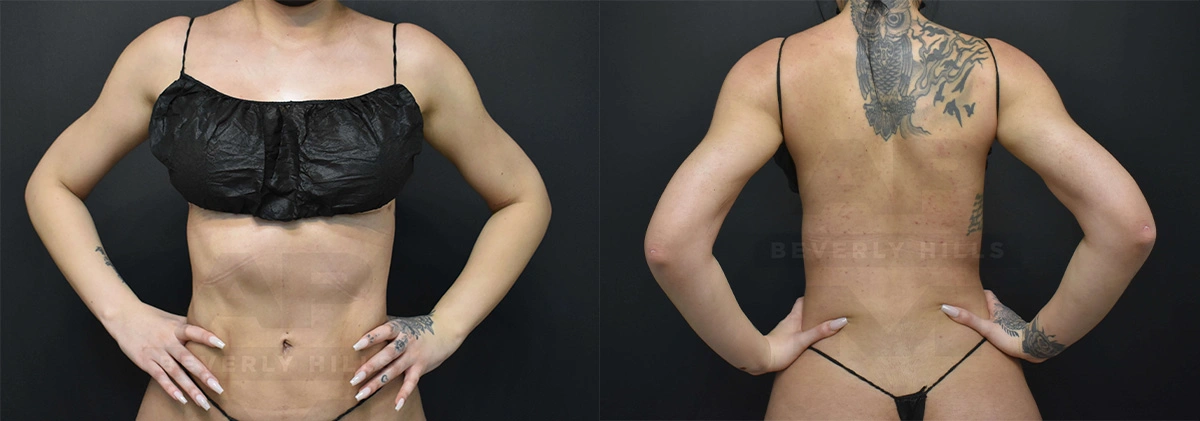 Real Patient Results of Dr. Andre P. Marshall providing Plastic Surgery services to his Beverly Hills & Los Angeles patients.