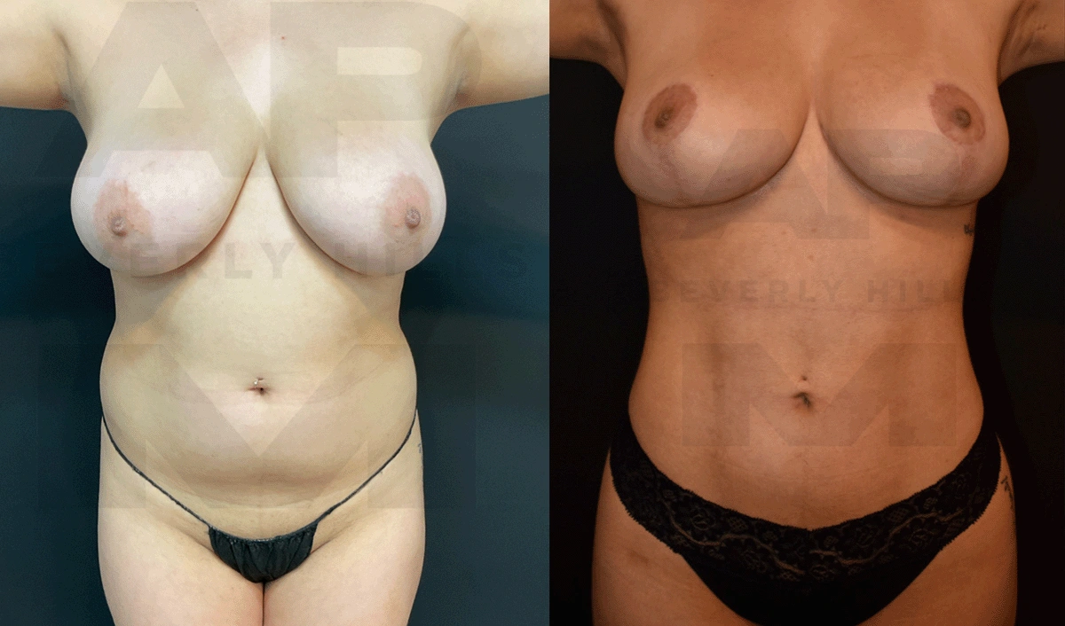 After Front (4 months) arms up.jpg