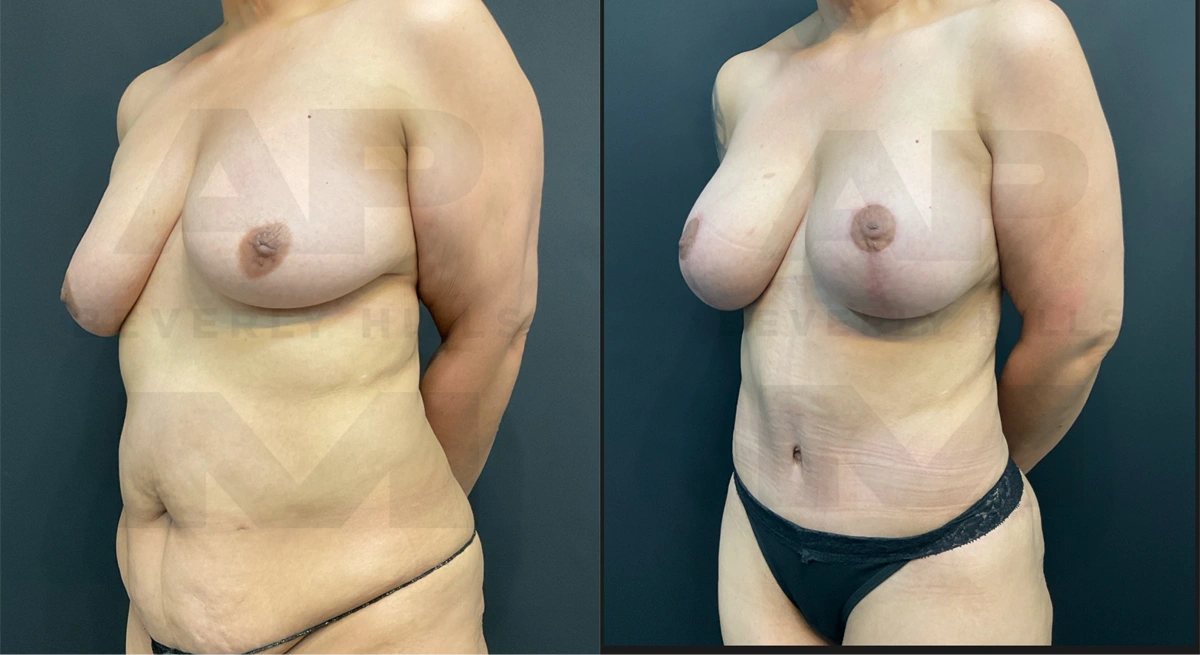 After Front Left Oblique 2.jpg