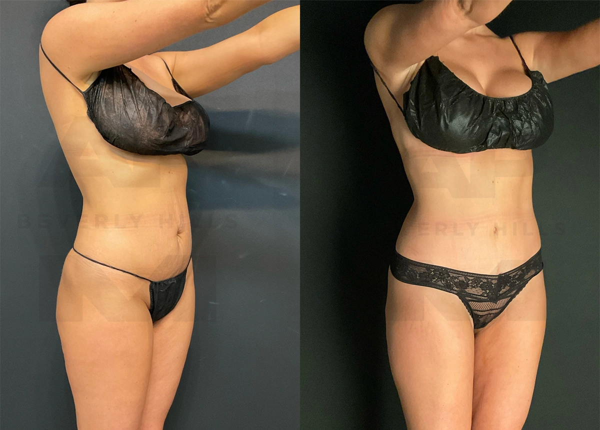 After Front Right Oblique_.jpg