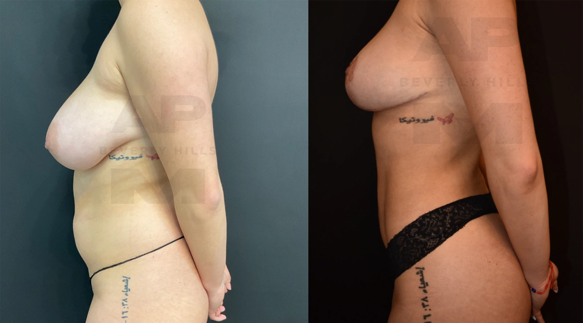 After Left Side (4 months).jpg