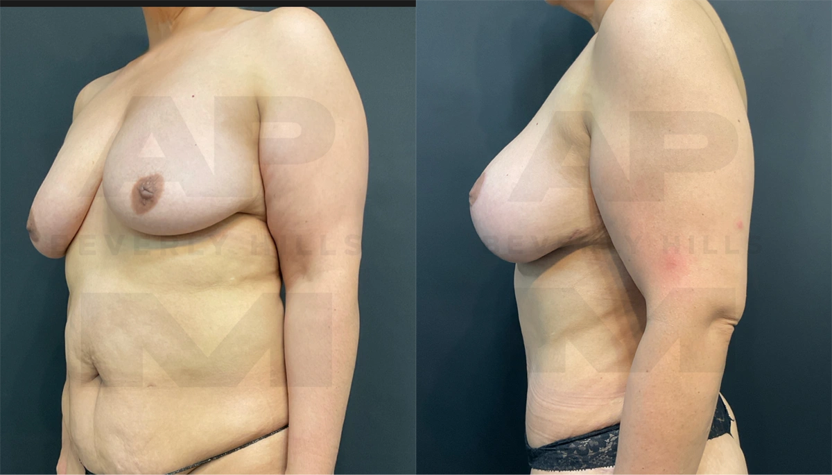 After Left Side_.jpg