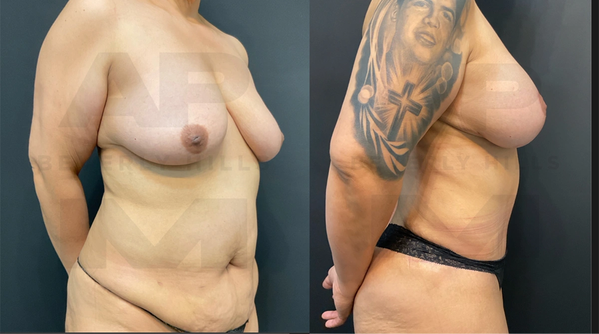 After Right Side 2_.jpg