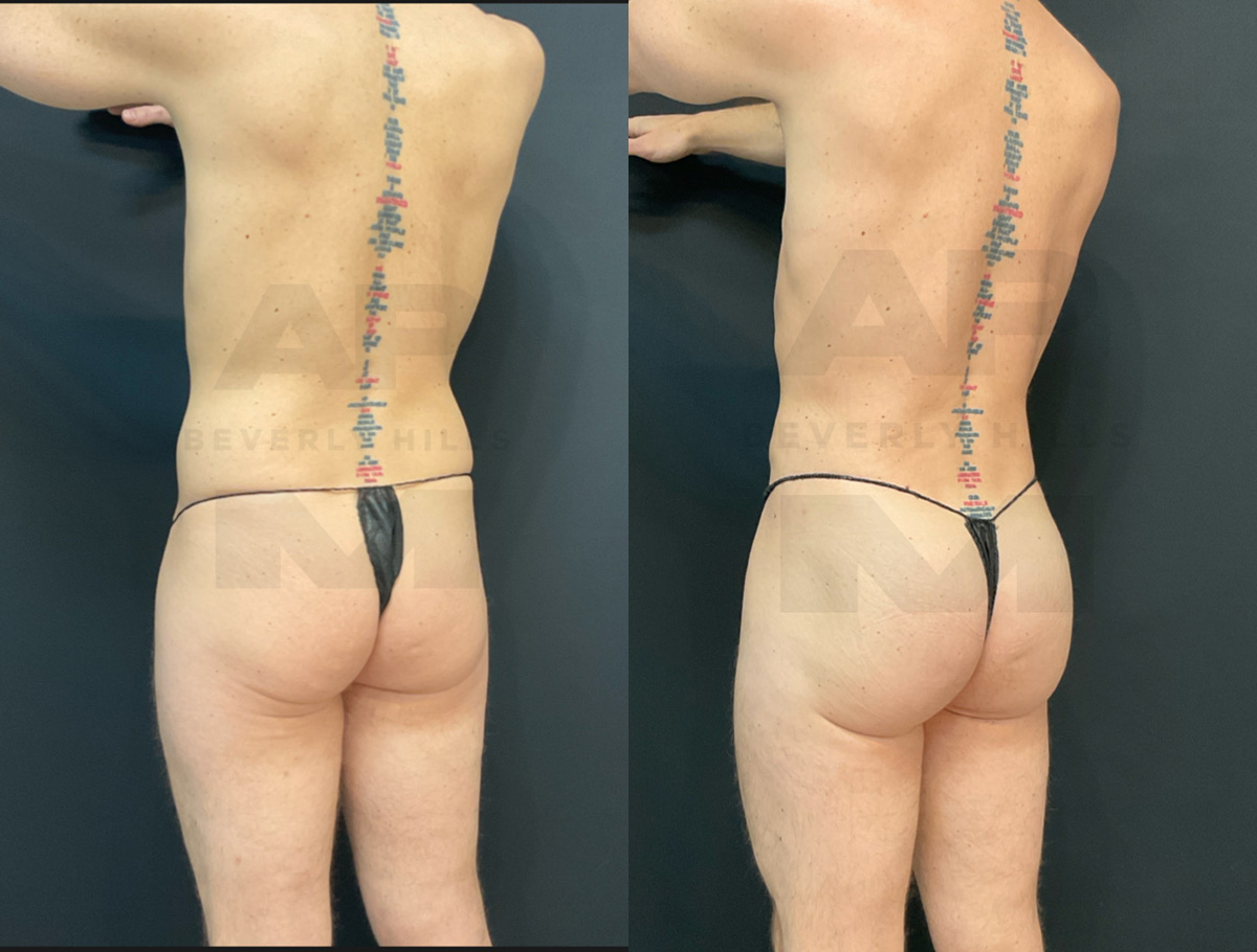 Before Back Left Oblique_