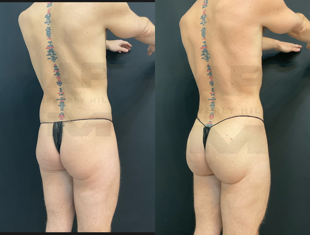 Before Back Right Oblique_