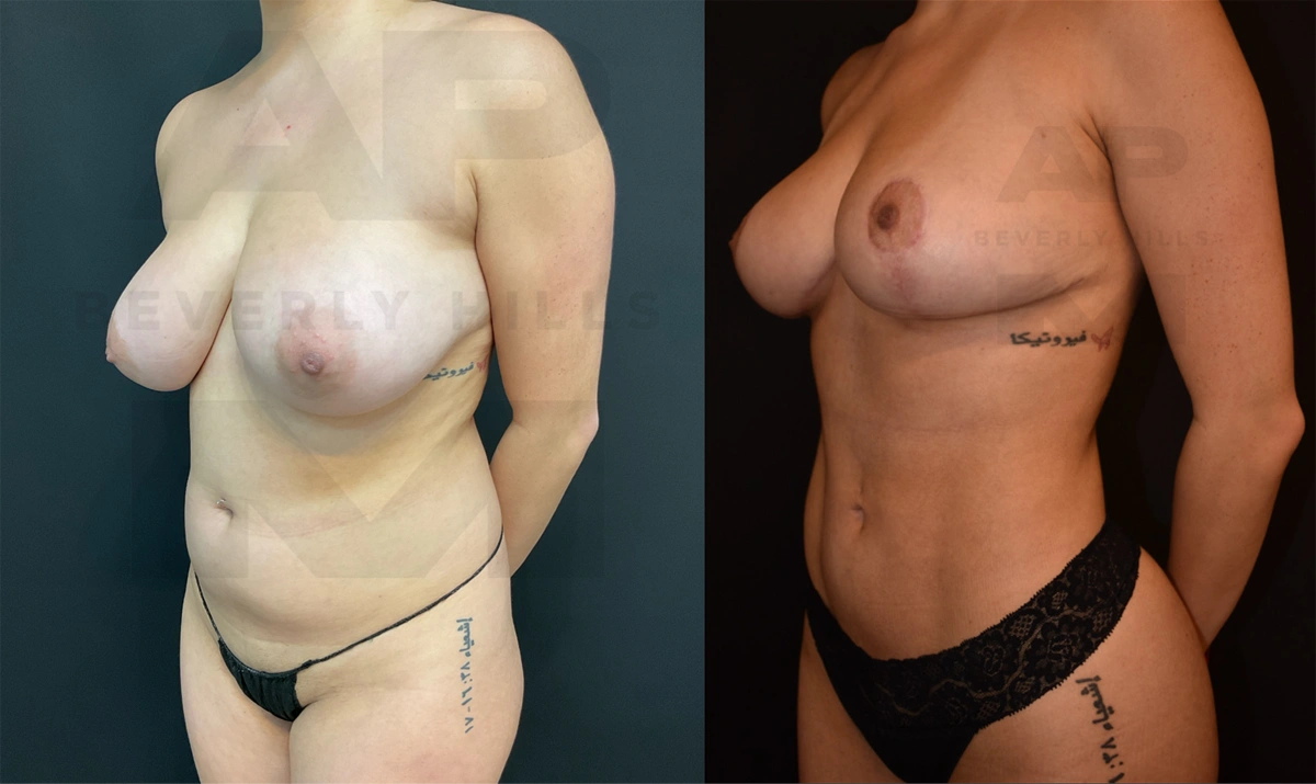 Before Front Left Oblique_.jpg