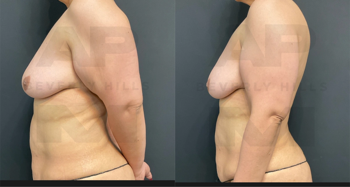 Before Left Side 2_.jpg