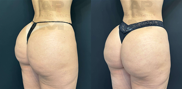 Real Patient Results of Dr. Andre P. Marshall providing Plastic Surgery services to his Beverly Hills & Los Angeles patients.