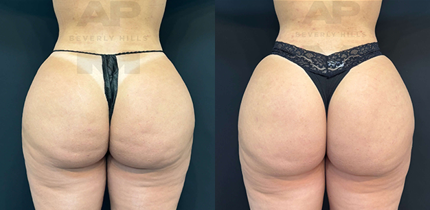 Real Patient Results of Dr. Andre P. Marshall providing Plastic Surgery services to his Beverly Hills & Los Angeles patients.