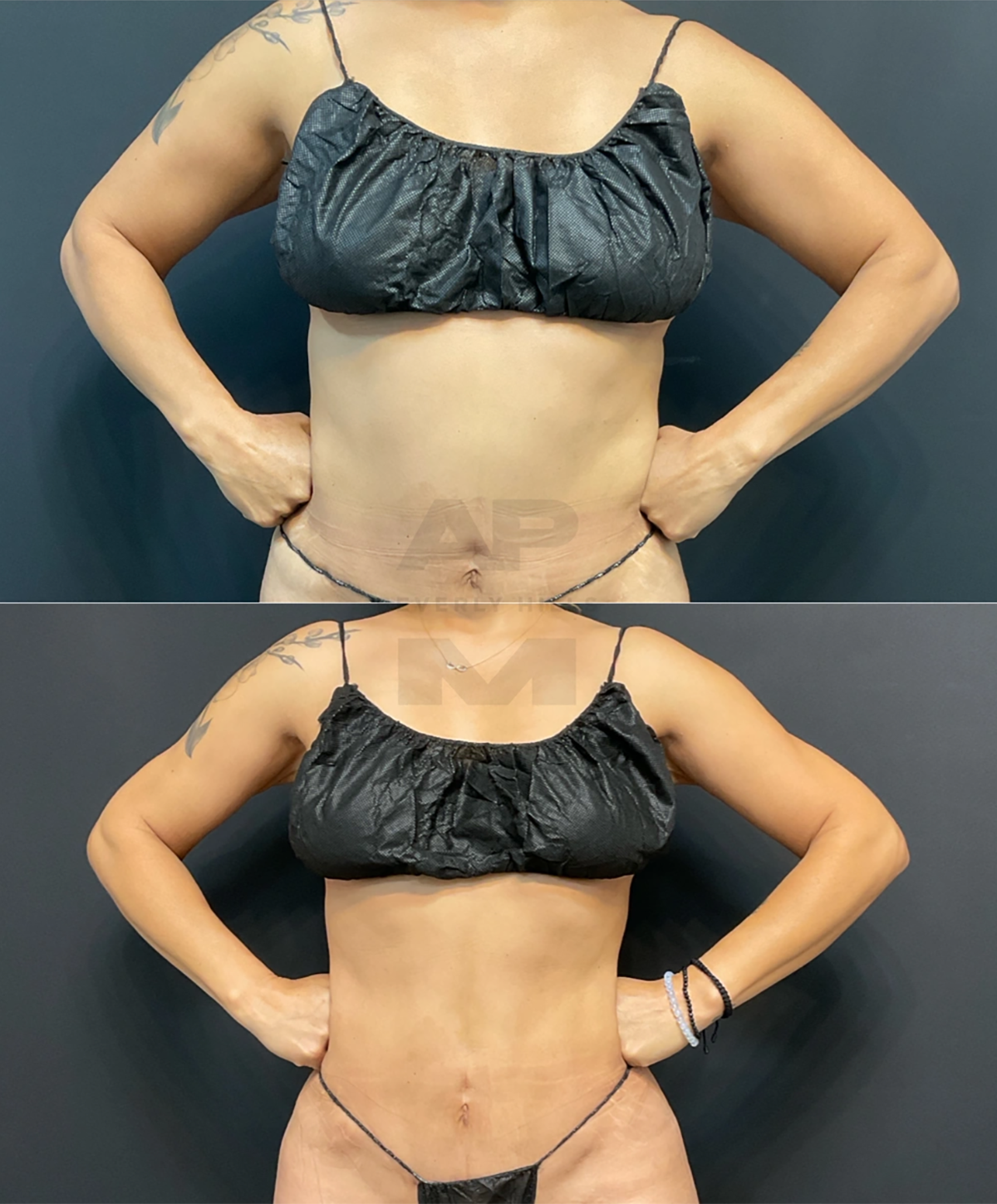 Real Patient Results by Dr. Marshall or Andrew P. Marshall Plastic Surgery serving Beverly Hills & Los Angeles, CA