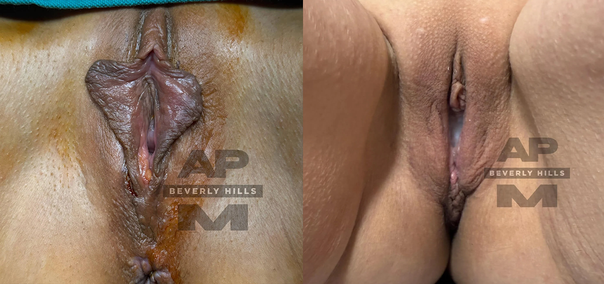 Real Patient Results of Dr. Andre P. Marshall providing Plastic Surgery services to his Beverly Hills & Los Angeles patients.