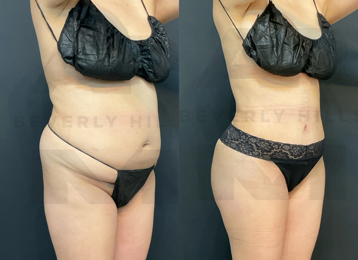 Real Patient Results by Dr. Marshall or Andrew P. Marshall Plastic Surgery serving Beverly Hills & Los Angeles, CA