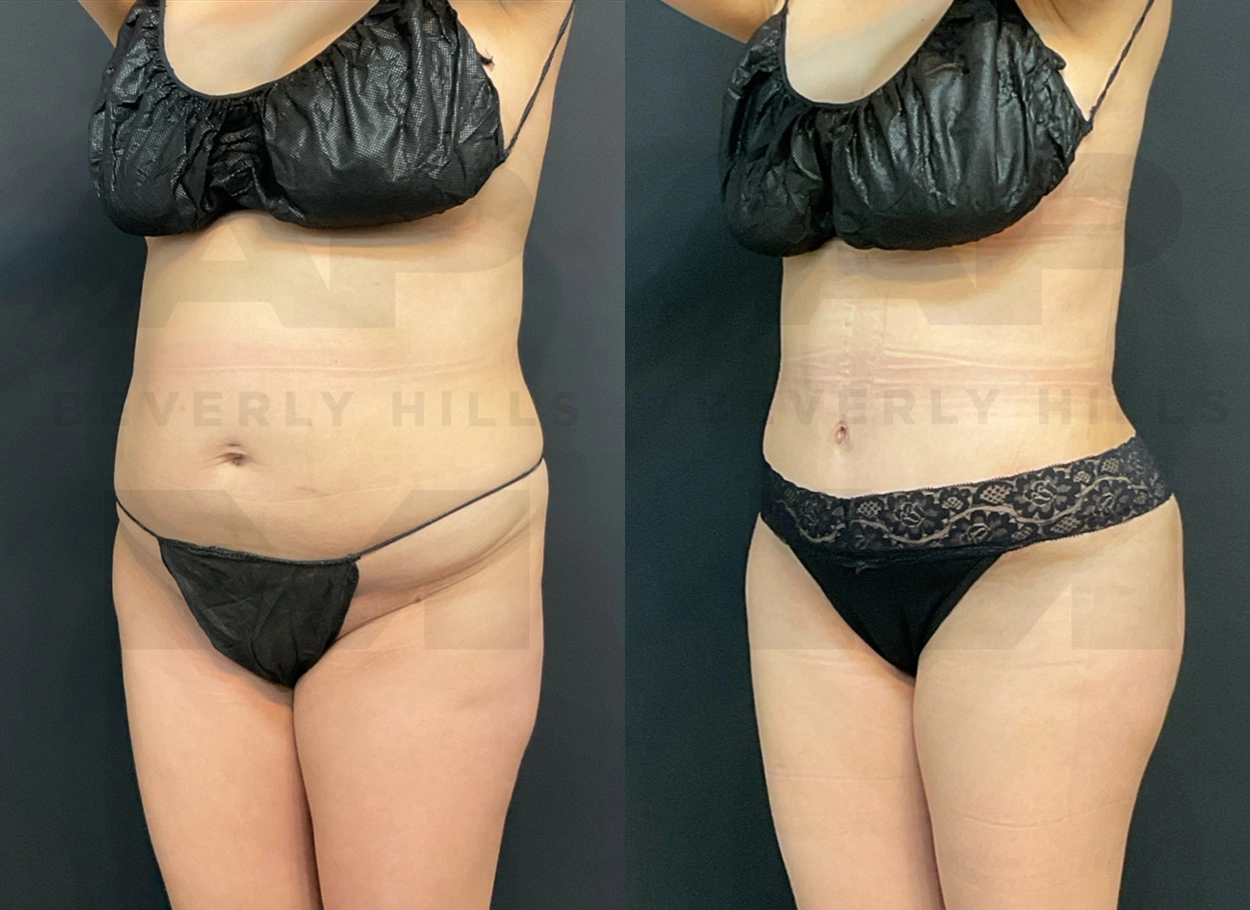 Real Patient Results by Dr. Marshall or Andrew P. Marshall Plastic Surgery serving Beverly Hills & Los Angeles, CA