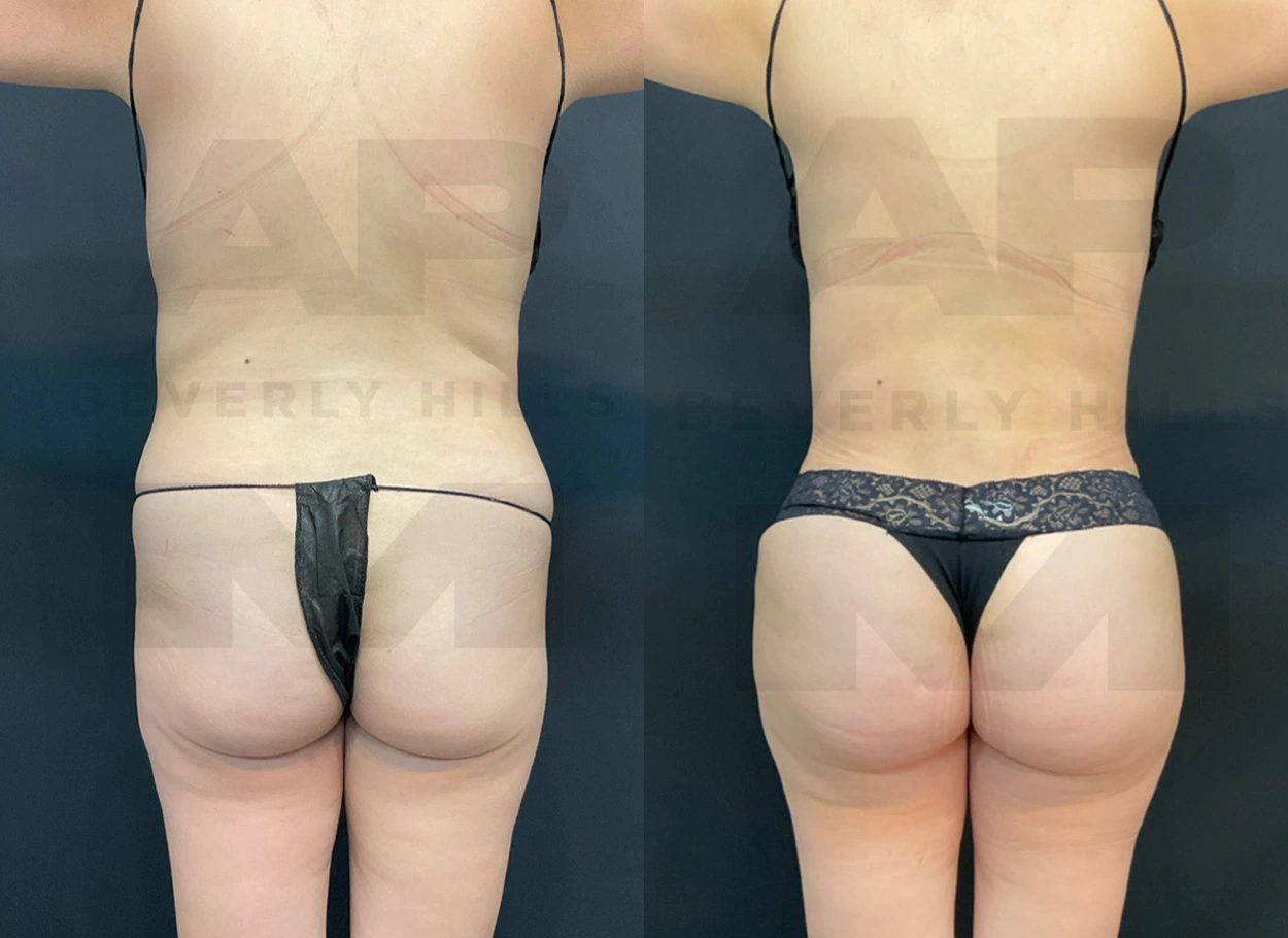 Real Patient Results by Dr. Marshall or Andrew P. Marshall Plastic Surgery serving Beverly Hills & Los Angeles, CA