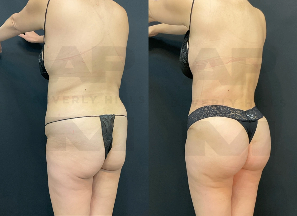 Real Patient Results by Dr. Marshall or Andrew P. Marshall Plastic Surgery serving Beverly Hills & Los Angeles, CA