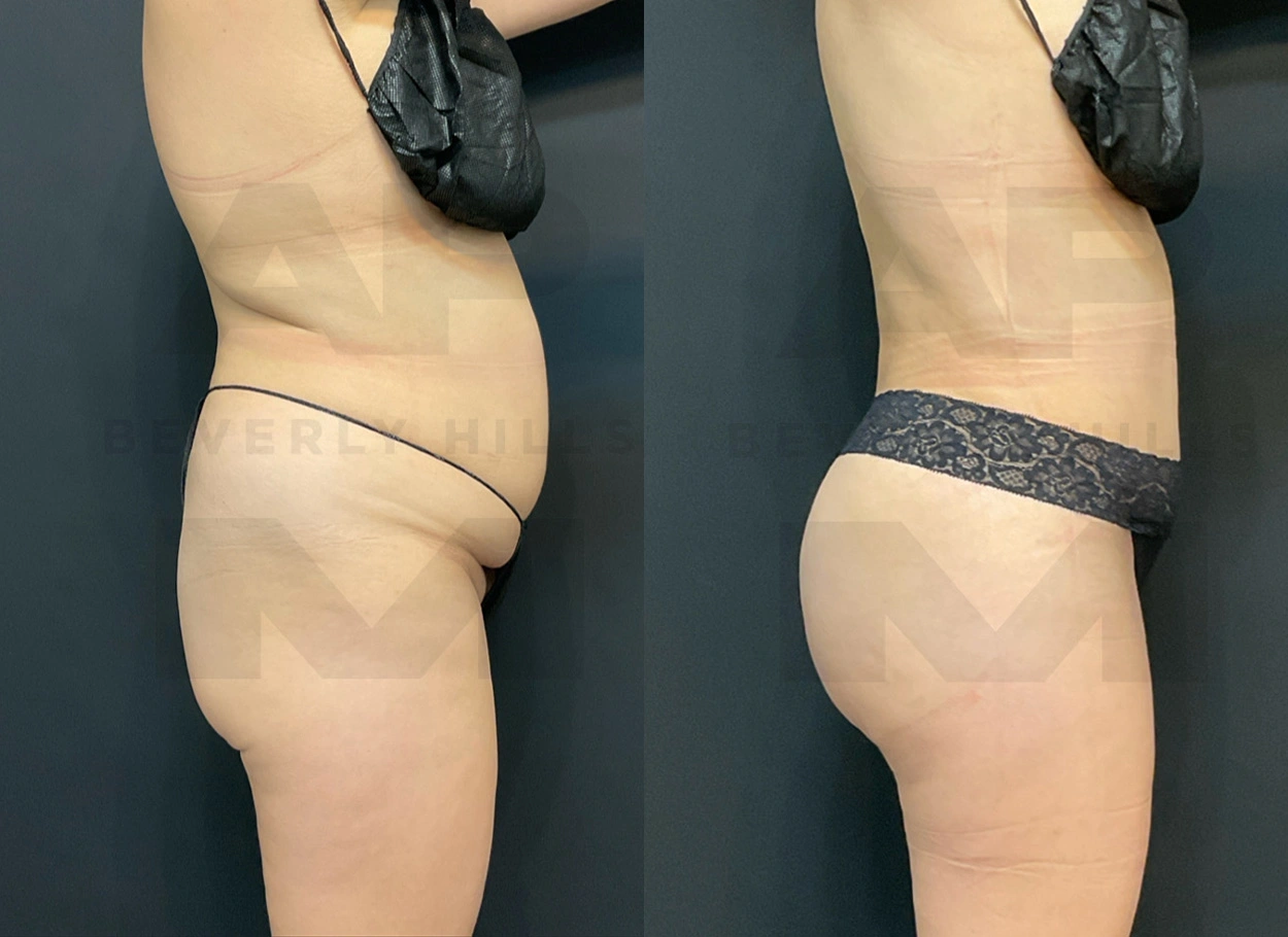 Real Patient Results by Dr. Marshall or Andrew P. Marshall Plastic Surgery serving Beverly Hills & Los Angeles, CA