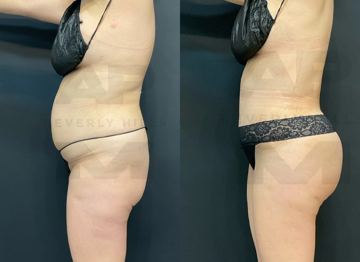 Real Patient Results by Dr. Marshall or Andrew P. Marshall Plastic Surgery serving Beverly Hills & Los Angeles, CA