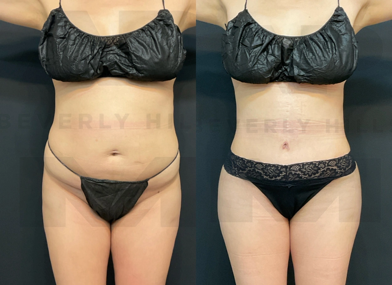 Real Patient Results by Dr. Marshall or Andrew P. Marshall Plastic Surgery serving Beverly Hills & Los Angeles, CA