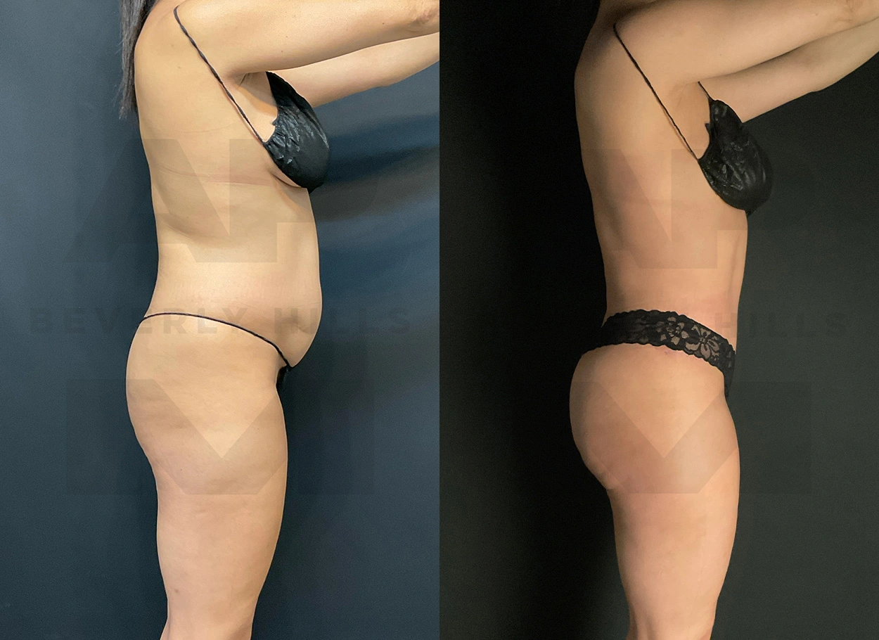 Real Patient Results by Dr. Marshall or Andrew P. Marshall Plastic Surgery serving Beverly Hills & Los Angeles, CA