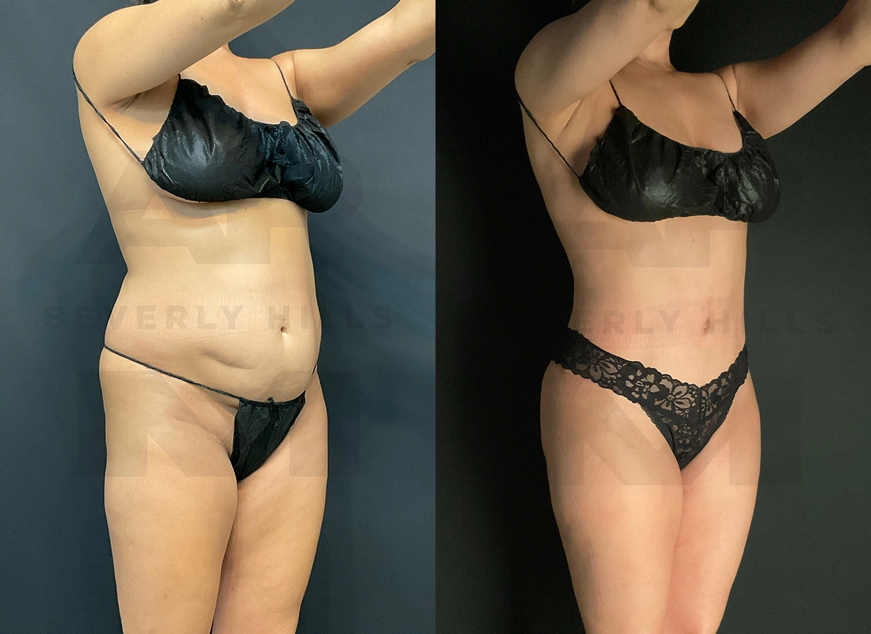 Real Patient Results by Dr. Marshall or Andrew P. Marshall Plastic Surgery serving Beverly Hills & Los Angeles, CA