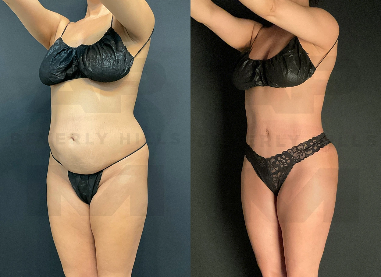 Real Patient Results by Dr. Marshall or Andrew P. Marshall Plastic Surgery serving Beverly Hills & Los Angeles, CA