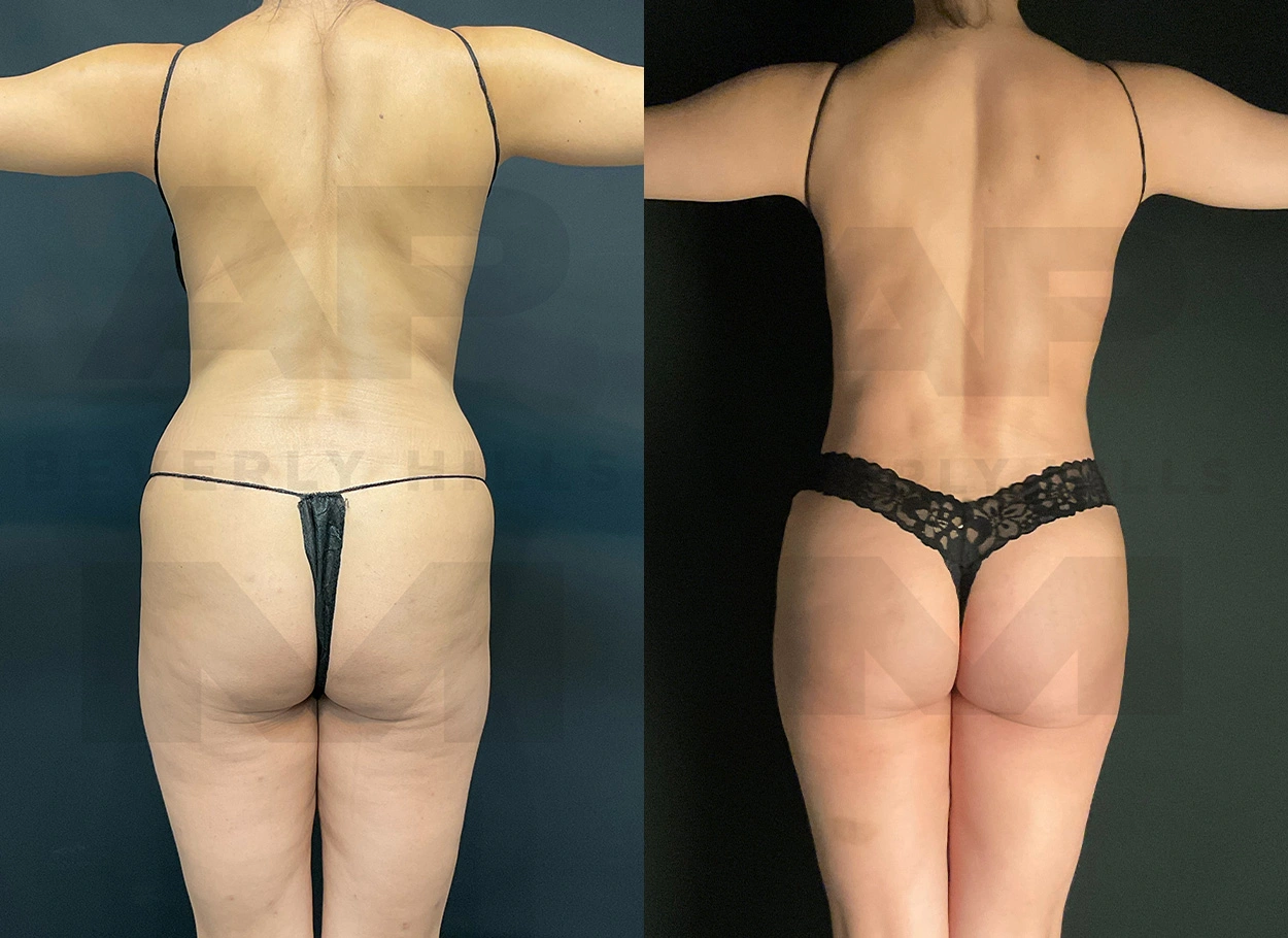 Real Patient Results by Dr. Marshall or Andrew P. Marshall Plastic Surgery serving Beverly Hills & Los Angeles, CA