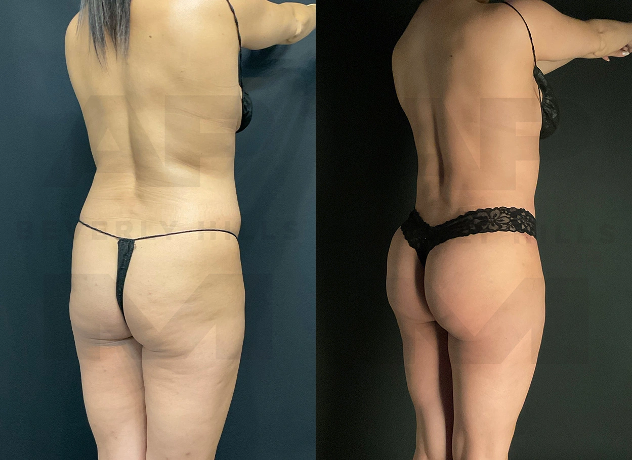 Real Patient Results by Dr. Marshall or Andrew P. Marshall Plastic Surgery serving Beverly Hills & Los Angeles, CA