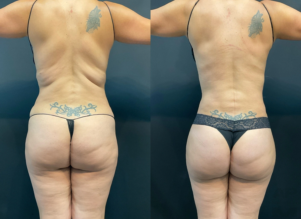 Real Patient Results by Dr. Marshall or Andrew P. Marshall Plastic Surgery serving Beverly Hills & Los Angeles, CA