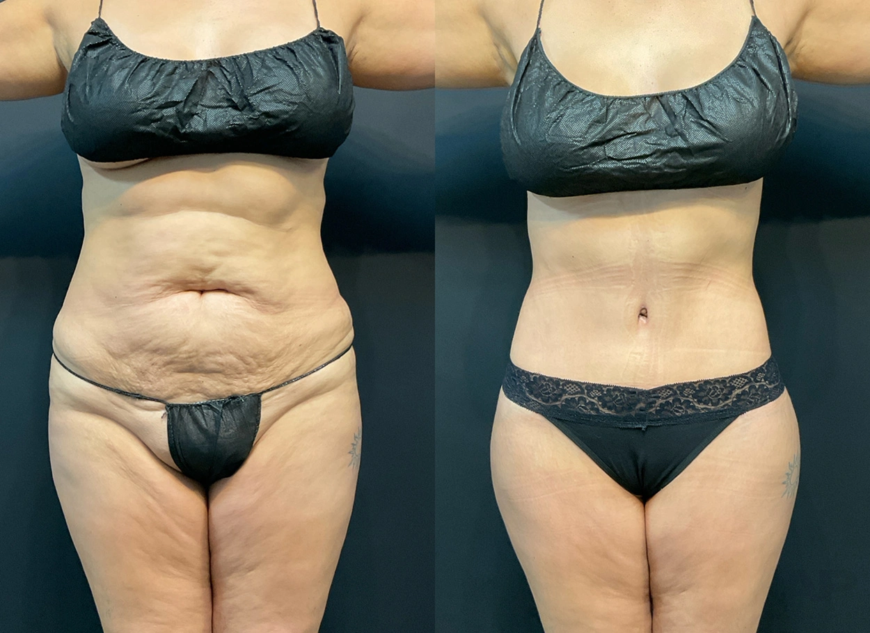 Real Patient Results by Dr. Marshall or Andrew P. Marshall Plastic Surgery serving Beverly Hills & Los Angeles, CA