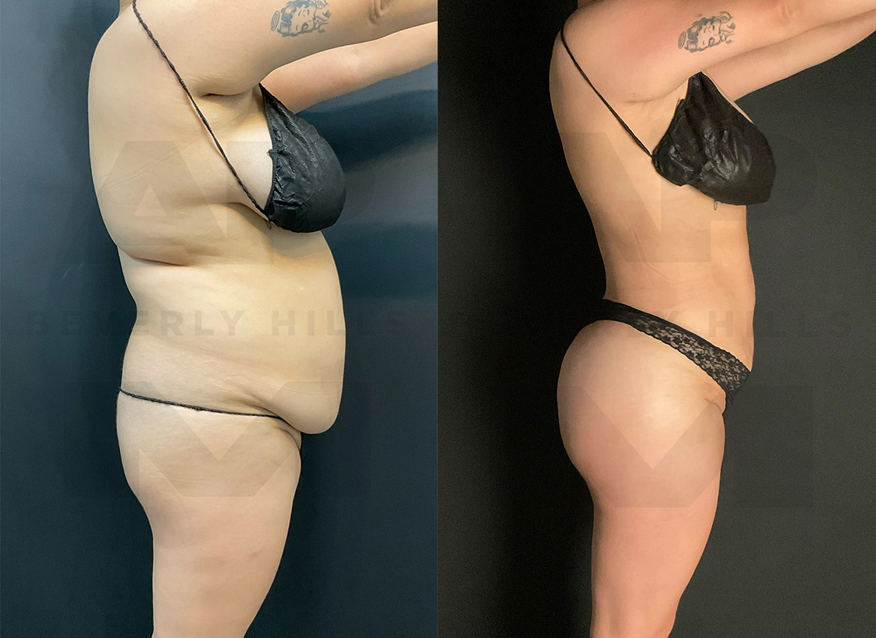 Real Patient Results by Dr. Marshall or Andrew P. Marshall Plastic Surgery serving Beverly Hills & Los Angeles, CA