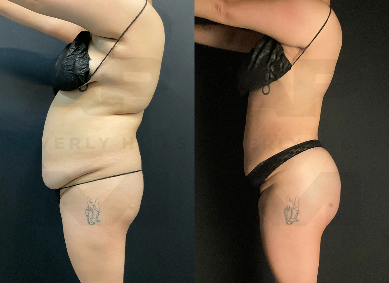 Real Patient Results by Dr. Marshall or Andrew P. Marshall Plastic Surgery serving Beverly Hills & Los Angeles, CA