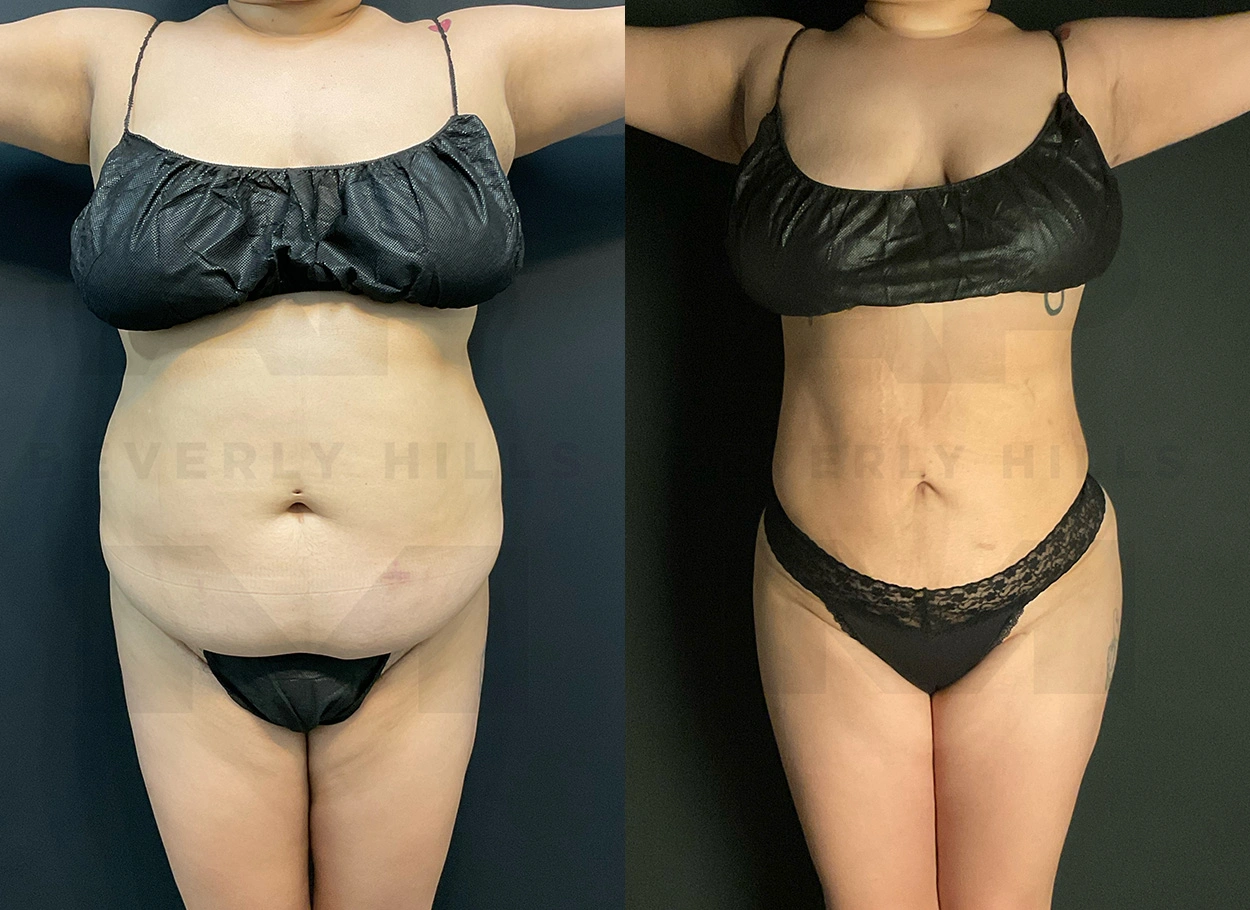 Real Patient Results by Dr. Marshall or Andrew P. Marshall Plastic Surgery serving Beverly Hills & Los Angeles, CA