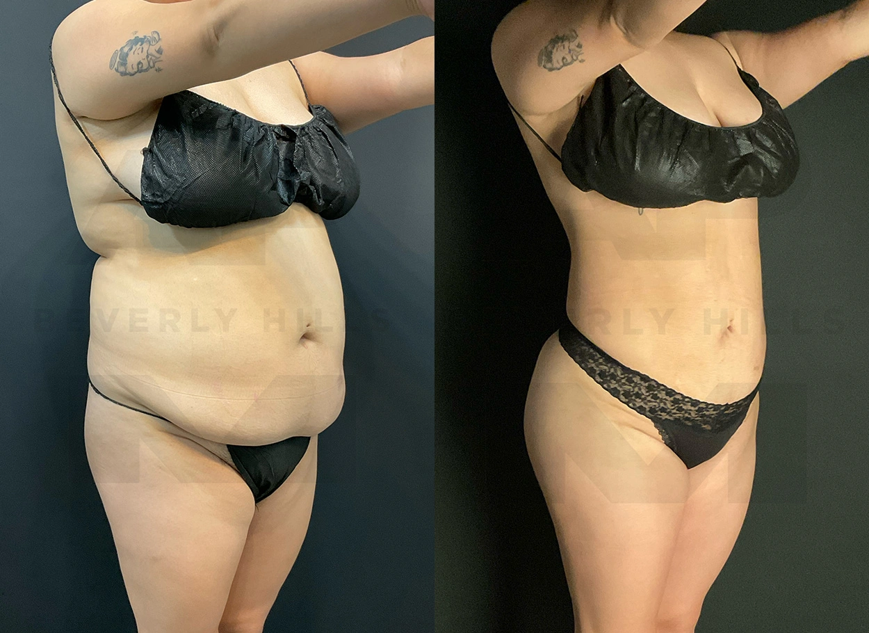 Real Patient Results by Dr. Marshall or Andrew P. Marshall Plastic Surgery serving Beverly Hills & Los Angeles, CA