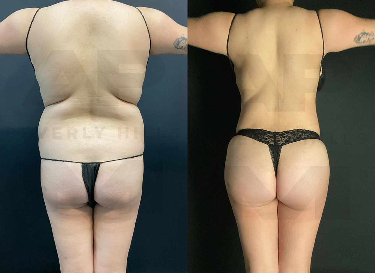 Real Patient Results by Dr. Marshall or Andrew P. Marshall Plastic Surgery serving Beverly Hills & Los Angeles, CA